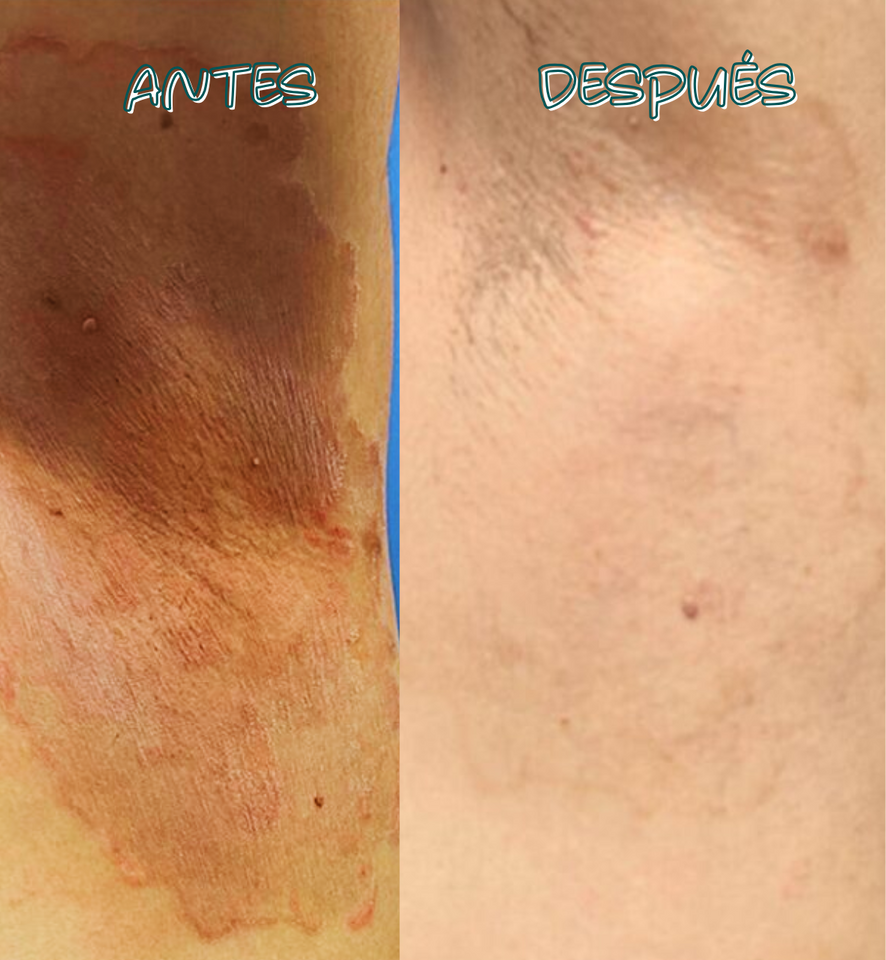 BIFONAZOL FORT ELIMINA LAS INFECCIONES EN LA PIEL